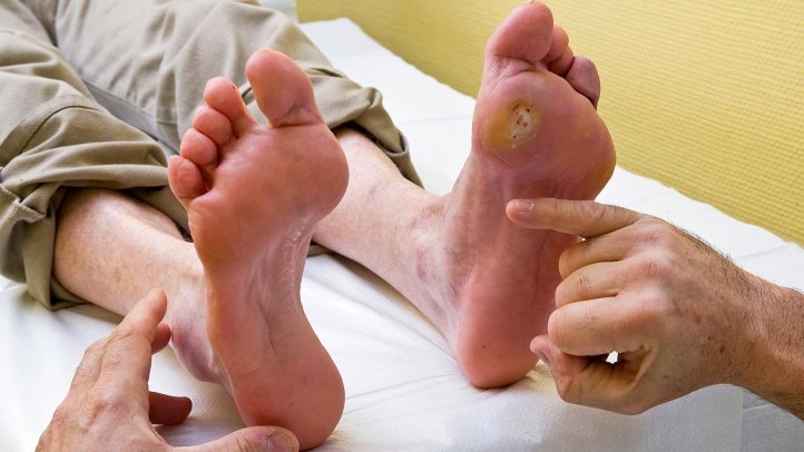 Market of Diabetic foot Ulcer Treatment by the end of 2025: A analysis